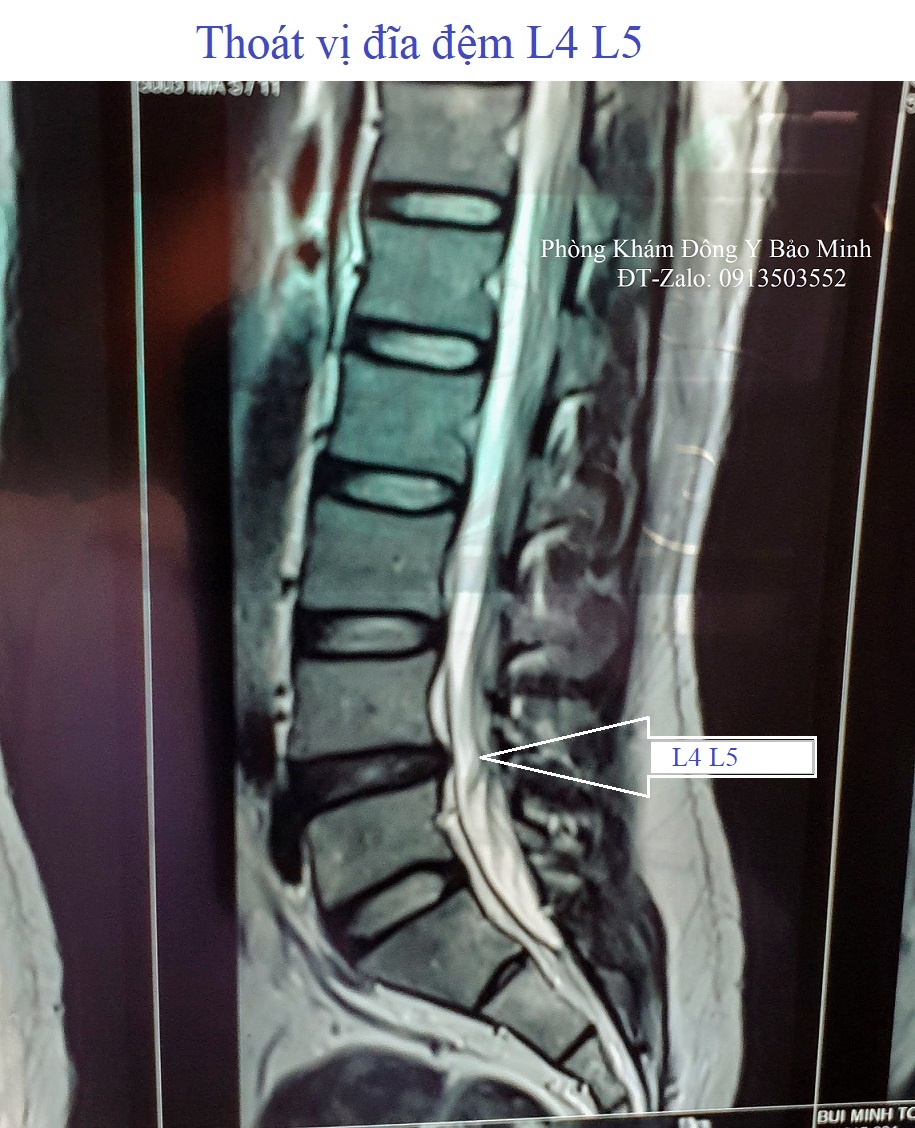 Thoát vị đĩa đệm L4 L5
